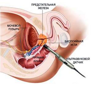 Изображение 1: Биопсия предстательной железы - клиника Семейный доктор