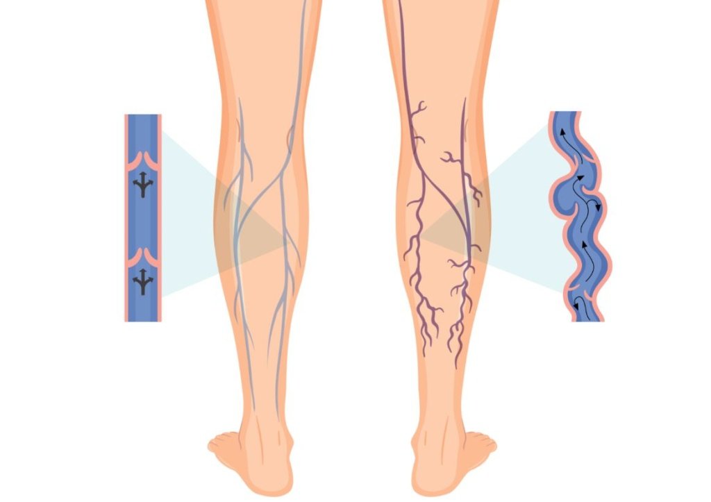 Хроническая венозная недостаточность - Сеть клиник АО Семейный доктор (Москва) - Изображение 1