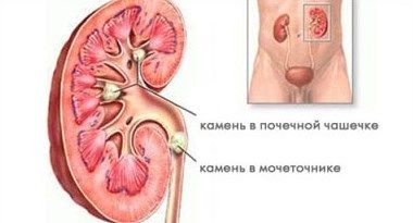 Мочекаменная болезнь