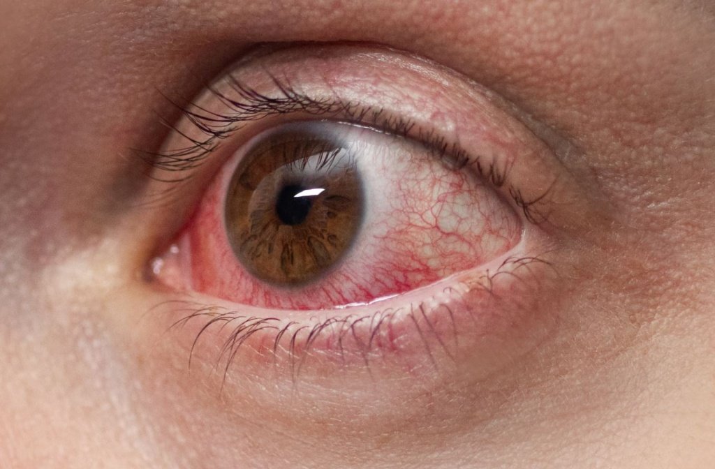 Иридоциклит