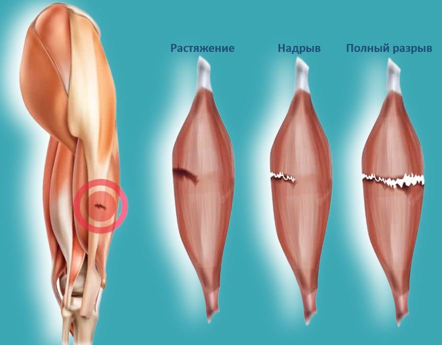 Разрыв мышцы - Сеть клиник АО Семейный доктор (Москва) - Изображение 1