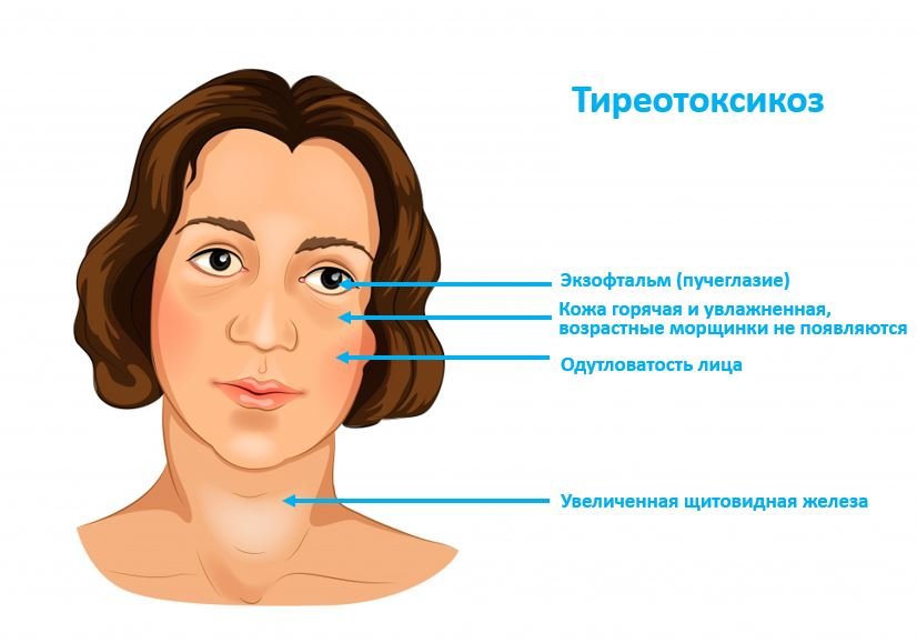 Тиреотоксикоз - Сеть клиник АО Семейный доктор (Москва) - Изображение 1