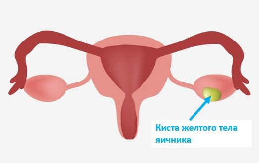 Киста желтого тела яичника - Сеть клиник АО Семейный доктор (Москва) - Изображение 1