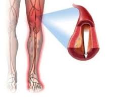Критическая ишемия левой ноги