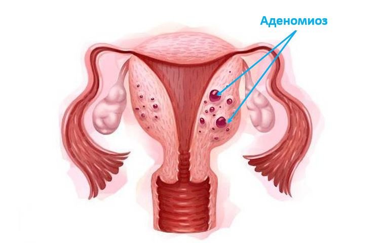 Аденомиоз - Сеть клиник Семейный доктор (Москва) - Изображение 1