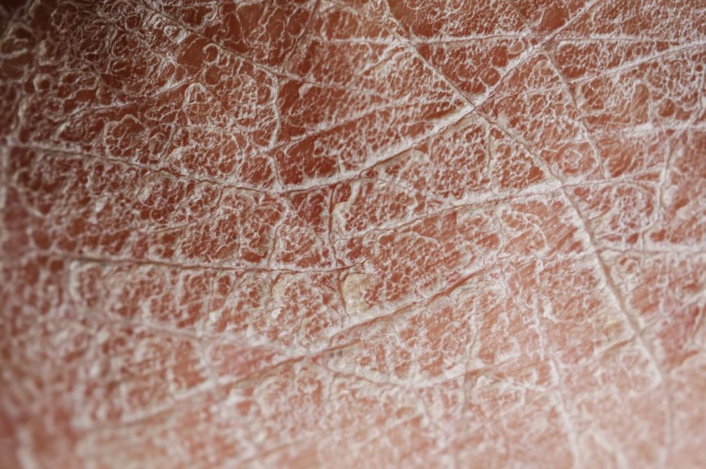 Гиперкератоз - Сеть клиник АО Семейный доктор (Москва) - Изображение 1.