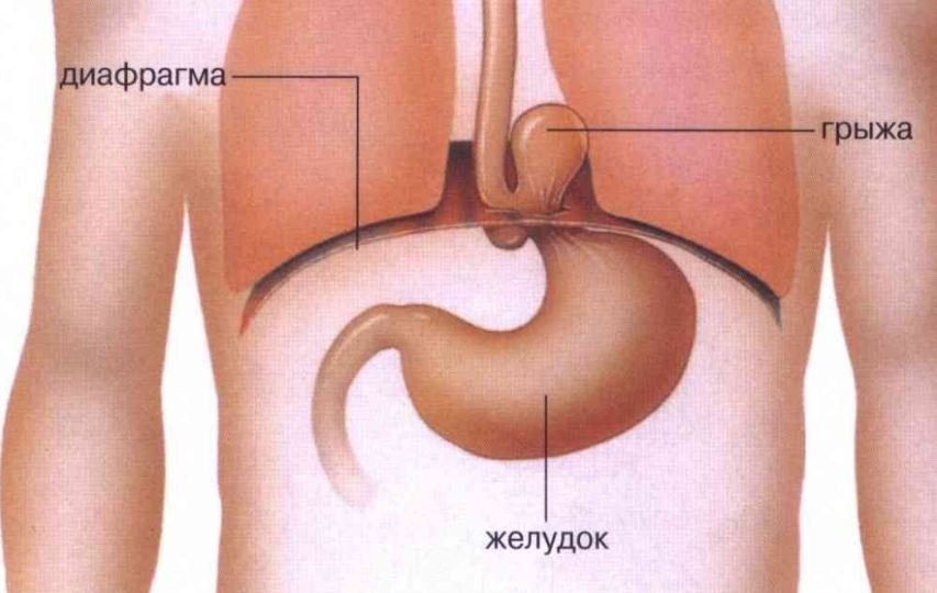 Диафрагмальная грыжа