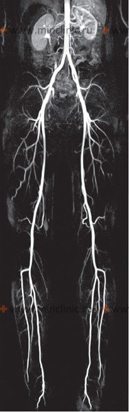 КТ-ангиография подвздошных артерий и нижних конечностей - Сеть клиник АО Семейный доктор (Москва)