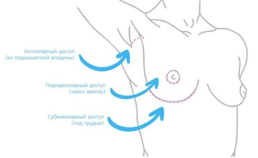 Маммопластика - Сеть клиник Семейный доктор (Москва) - Изображение 4
