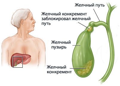 Доклад: Желчнокаменная болезнь