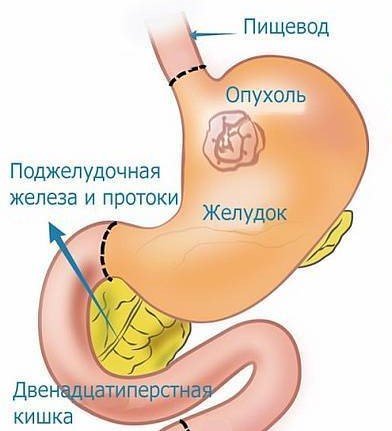 Удаление желудка - Сеть клиник АО Семейный доктор (Москва) - Изображение 1