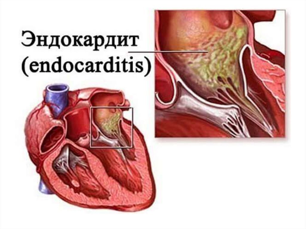 Эндокардит симптомы и лечение. Инфекционный эндокардит поражение клапанов. Септический эндокардит клапана сердца. Эндокардит аортального клапана симптомы.