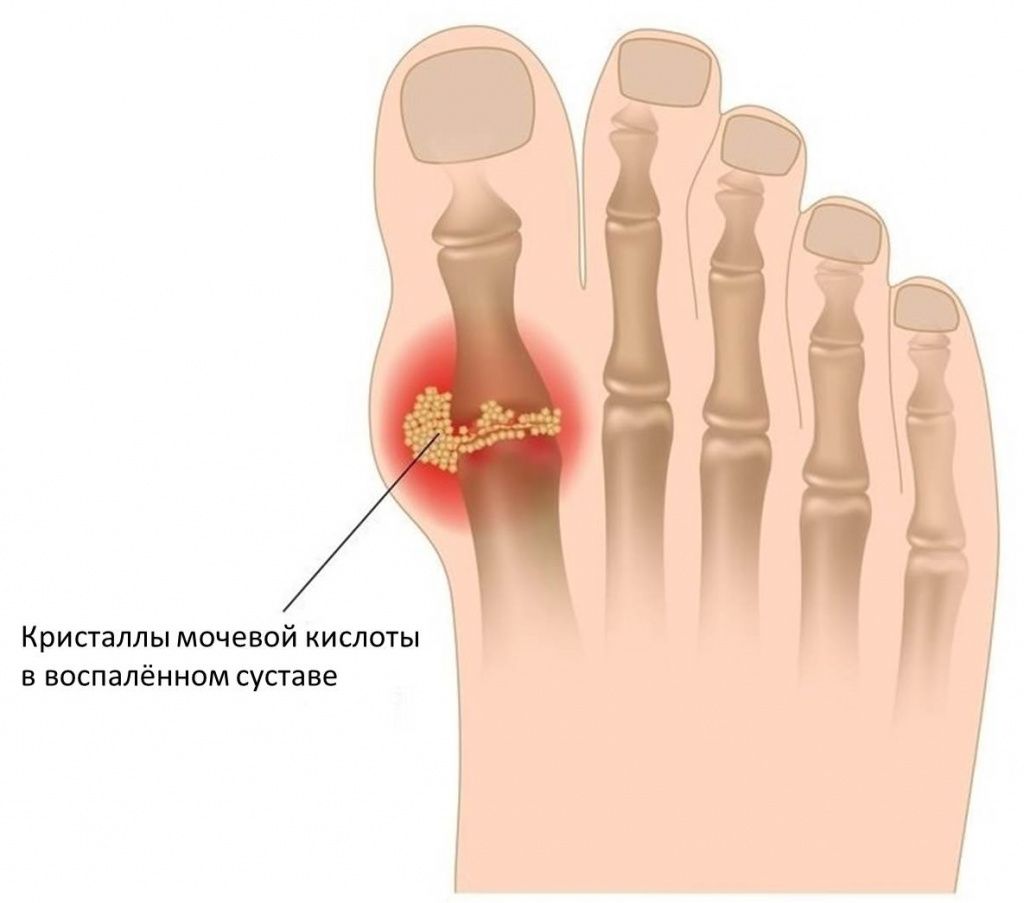 Подагра На Пальцах Ног Фото