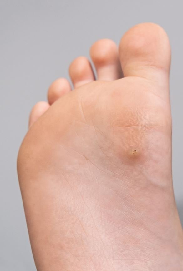 Стержневая мозоль - Сеть клиник АО Семейный доктор (Москва) - Изображение 1 