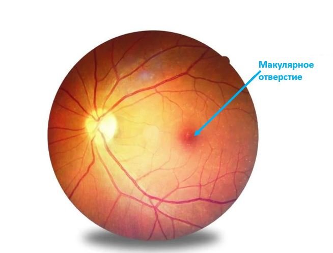 Макулярное отверстие - Сеть клиник АО Семейный доктор (Москва) - Изображение 1
