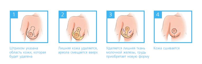 Маммопластика - Сеть клиник Семейный доктор (Москва) - Изображение 3
