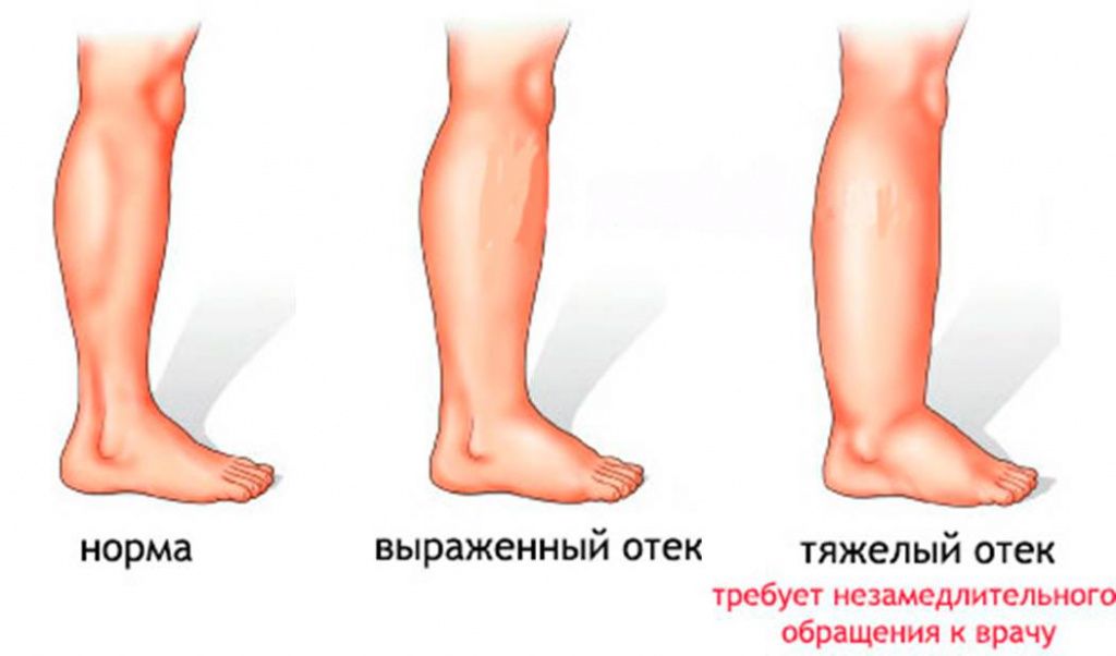 Почему отекают ноги. Отек голени или щиколотки - к какому врачу обращаться?