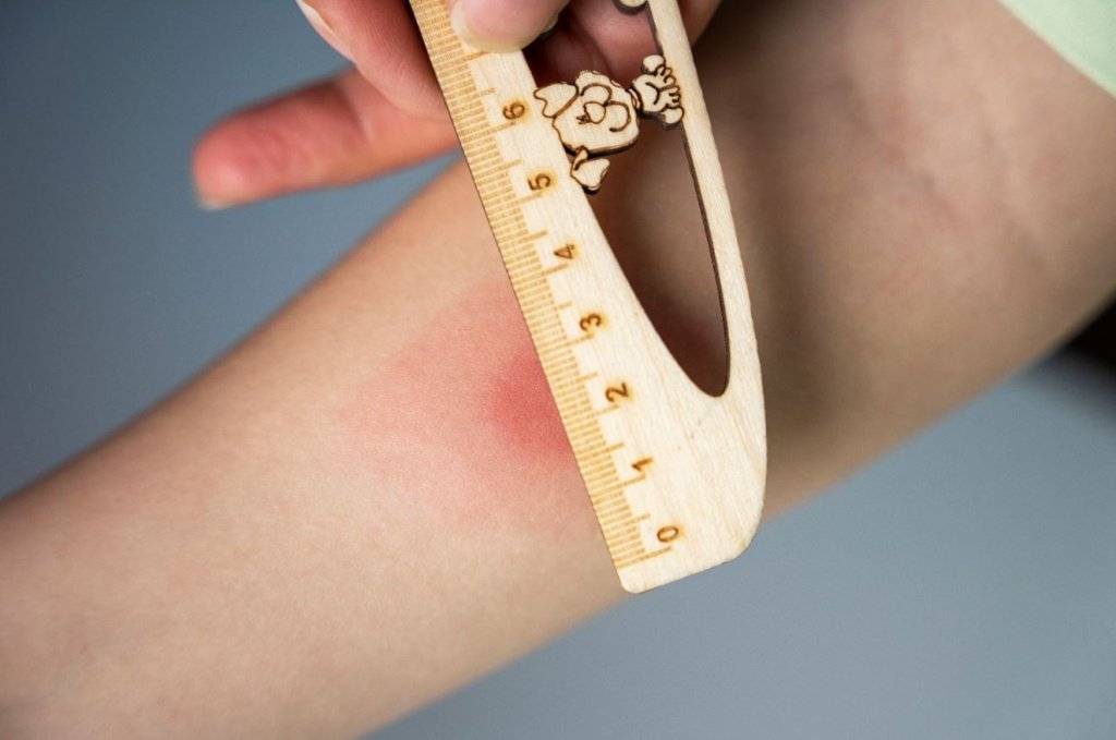 Что делать при положительной пробе Манту - Сеть клиник АО Семейный доктор (Москва) - Изображение 1