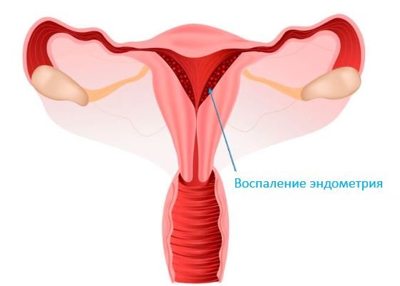 Эндометрит - Сеть клиник АО Семейный доктор (Москва) - Изображение 1