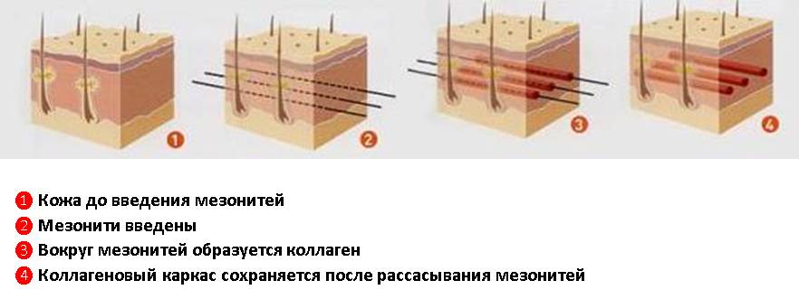 Мезонити: что это такое? Изображение 1: Мезонити Reandne - клиника Семейный доктор