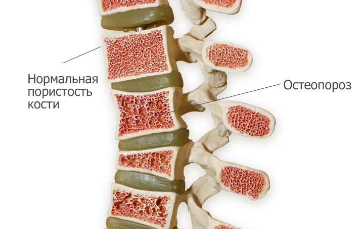Остеопороз: симптомы, диагностика и лечение остеопороза. Как ...